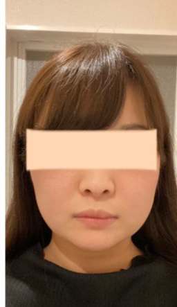 after画像