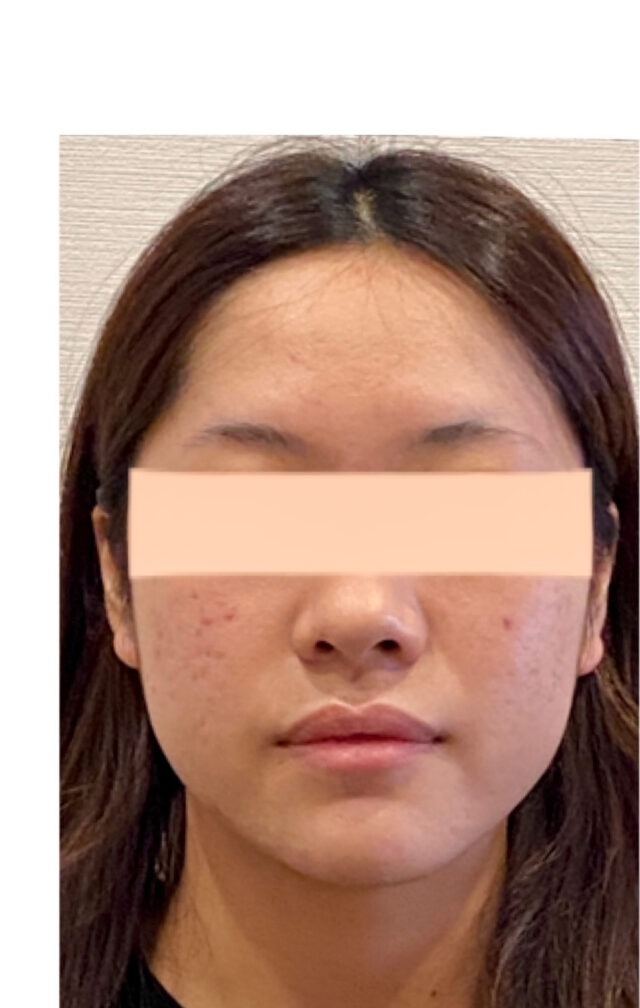 before画像