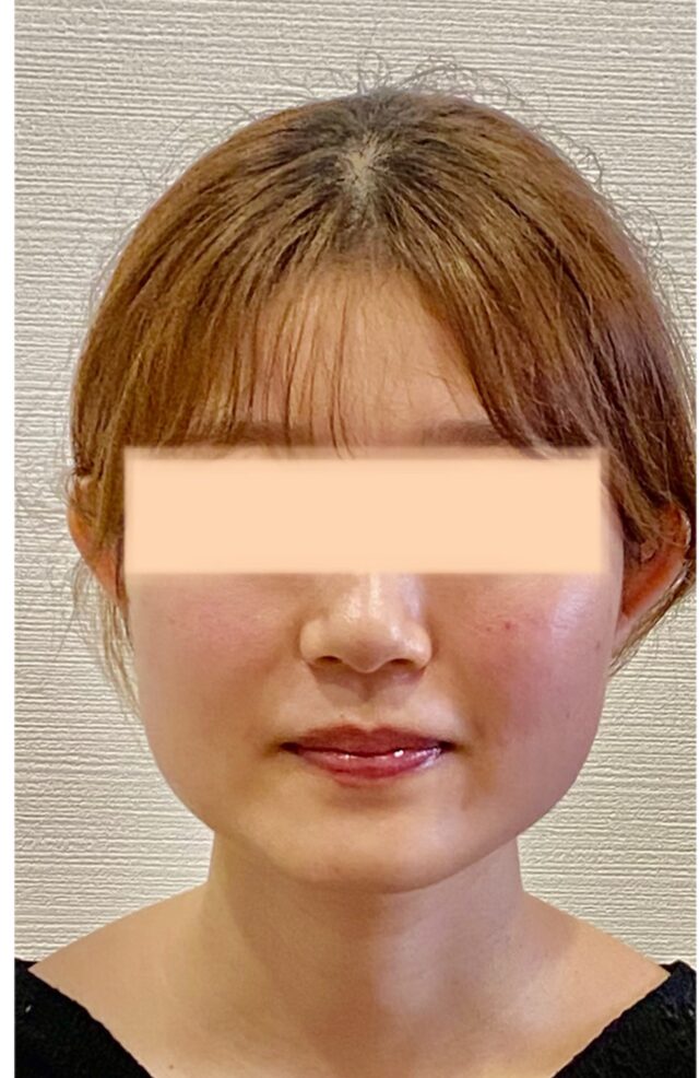before画像